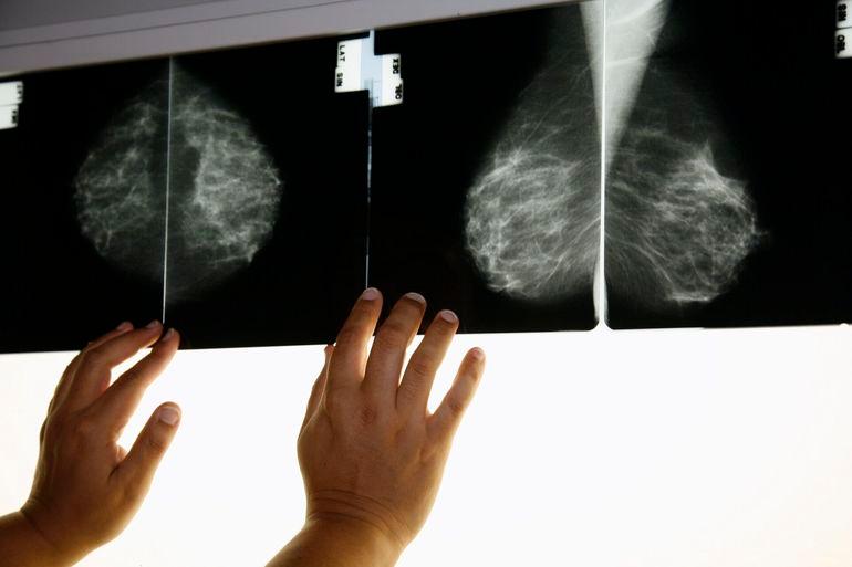 Region opfordrer kvinder med brystkræft til at søge erstatning
